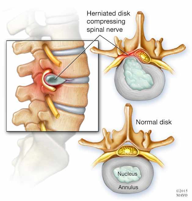 Prather-Non-Surgical Orthopedic Decompression Therapy 1 Prather-79cc41329fe0740068a6f0193e3eceb4